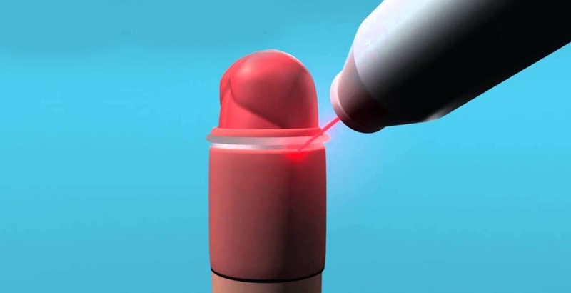 Cắt bao quy đầu bằng laser có an toàn không? Quy trình như thế nào? 3