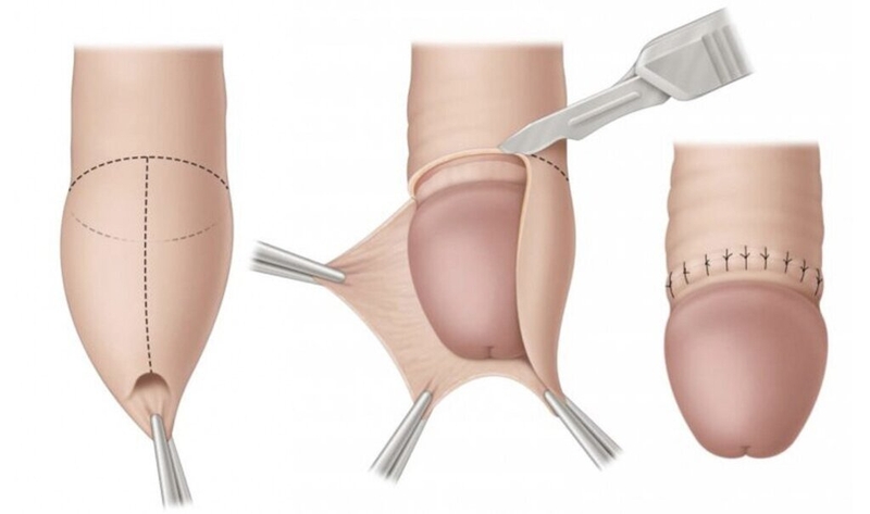 Cắt bao quy đầu cho trẻ: Chỉ định, chống chỉ định và những điều cần biết 1