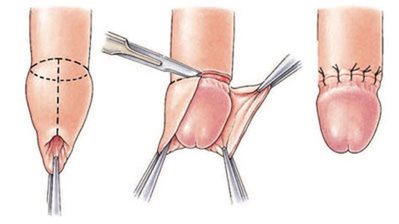 Cắt bao quy đầu có tác dụng gì? Những lợi ích không ngờ của phẫu thuật cắt bao quy đầu 2