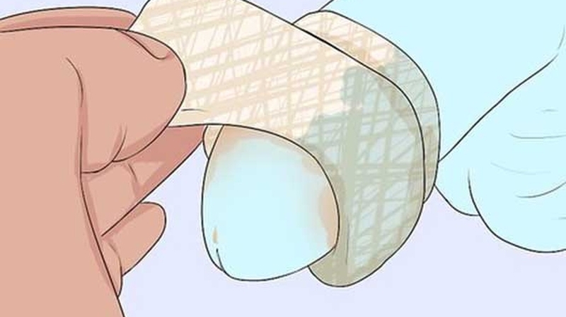 Cắt bao quy đầu có tác dụng gì? Những lợi ích không ngờ của phẫu thuật cắt bao quy đầu 4