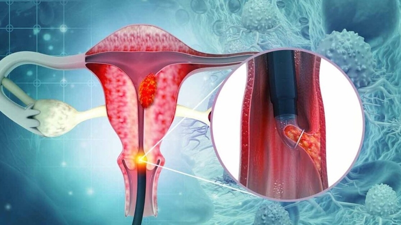 Cắt bỏ cổ tử cung: Những điều phụ nữ cần biết trước khi phẫu thuật 1