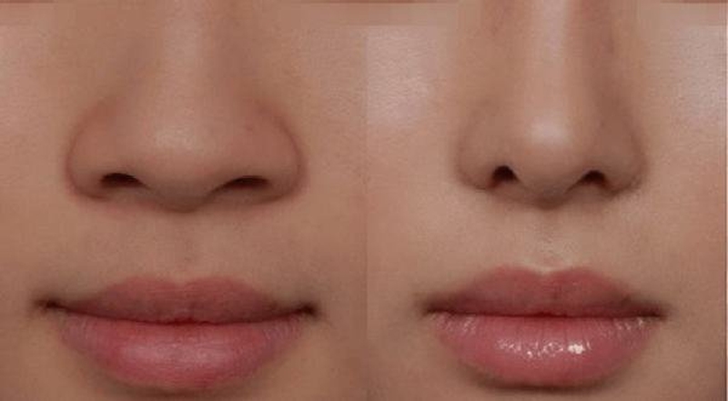 Trong trường hợp đầu mũi to, hai bên cánh mũi rộng việc cắt cánh mũi là hợp lý