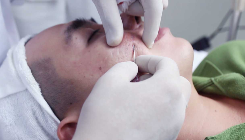 Cắt đáy sẹo kiêng ăn gì để nhanh phục hồi?1