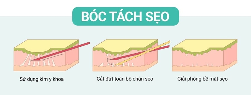 Cắt đáy sẹo là gì? Ưu và nhược điểm của cắt đáy sẹo 2