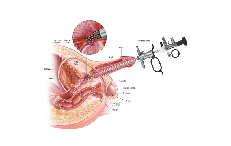 Tìm hiểu chi tiết về cắt đốt tuyến tiền liệt qua ngả niệu đạo 1