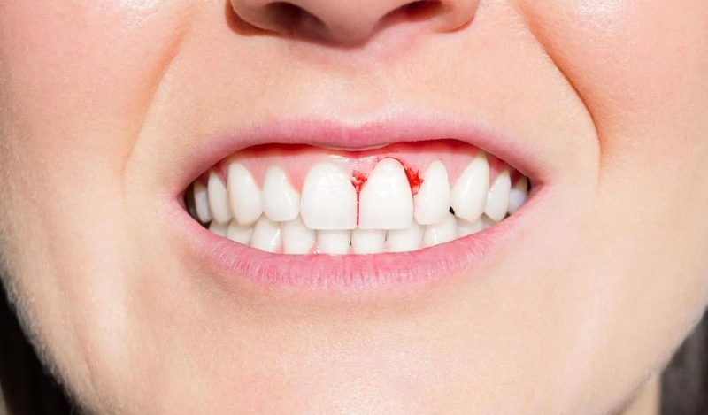 Cắt lợi có nguy hiểm không? Chăm sóc sau cắt lợi cho nhanh khỏi? 3