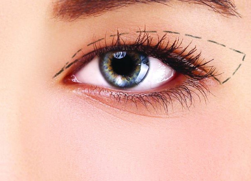 Cắt mí bao lâu hết sưng và khỏi hoàn toàn? 1