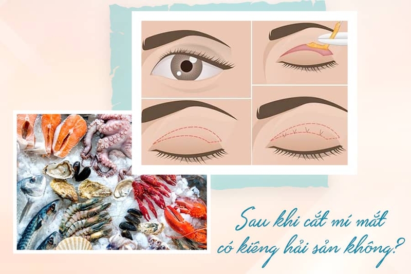 Cắt mí kiêng hải sản không? cắt mí kiêng hải sản bao lâu?1