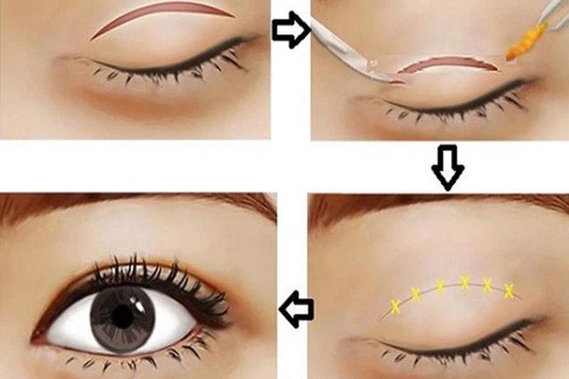 Cắt mí kiêng hải sản không? cắt mí kiêng hải sản bao lâu?3