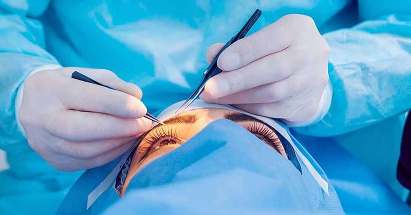 Cắt mí mắt có để lại sẹo không? Và những thông tin cần biết 2