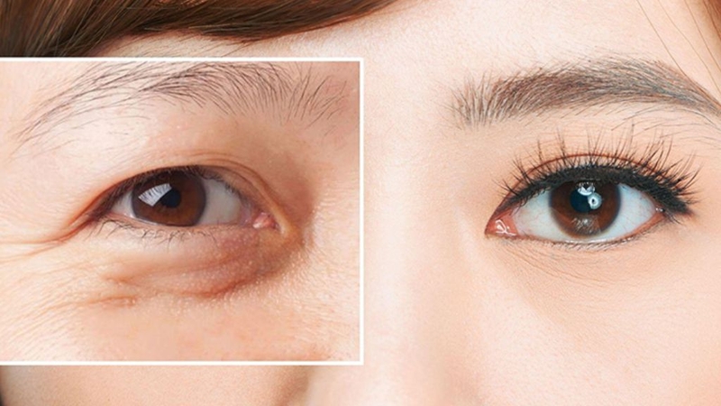 Cắt mí mini deep: Phương pháp thẩm mỹ được chị em ưa chuộng 1