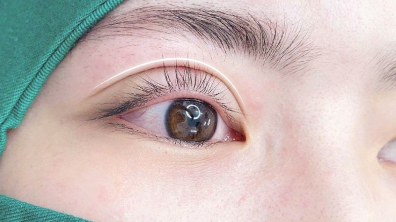 Cắt mí mini deep: Phương pháp thẩm mỹ được chị em ưa chuộng 2