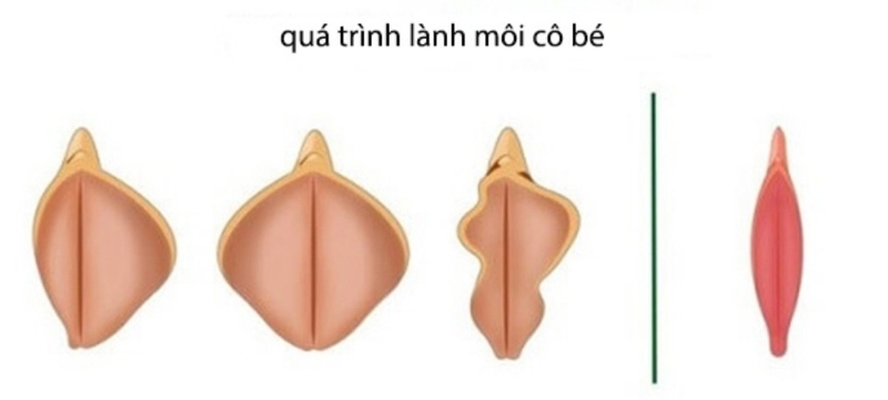 Cắt môi bé bao lâu thì lành? Những điều cần lưu ý khi thực hiện phẫu thuật cắt môi bé 3