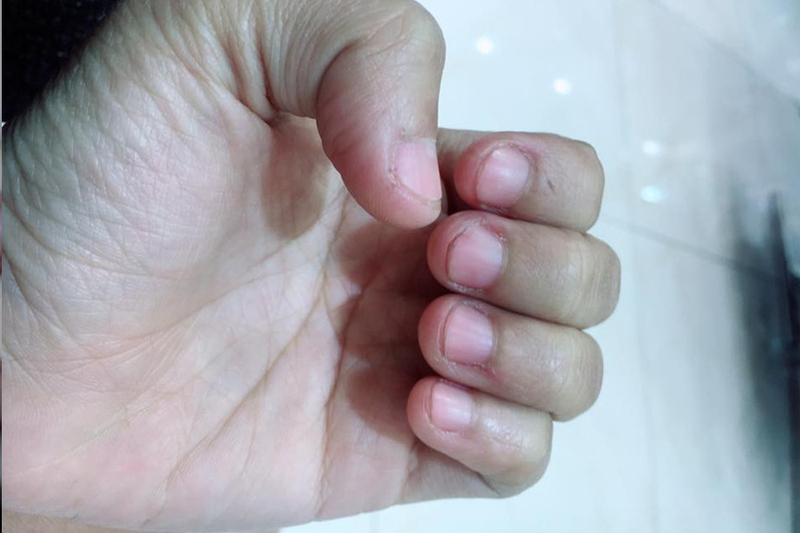 Thực hư việc cắt móng tay sát có bị bệnh tim không?