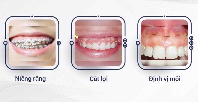 Cắt nướu bao lâu thì khỏi và cắt lợi có mọc lại không? 2