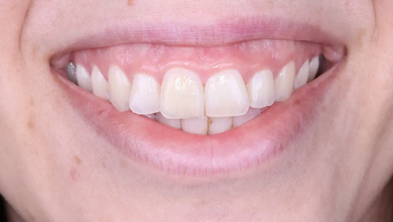 Cắt nướu răng là gì? 3 kỹ thuật cắt nướu răng hiện nay 2