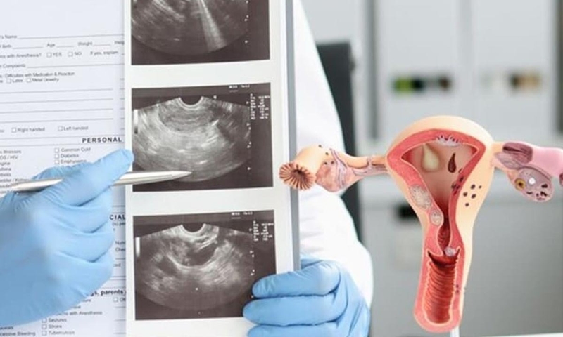 cat-polyp-co-tu-cung-het-bao-nhieu-tien 1.jpg