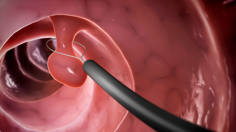 Cắt polyp dạ dày có phải nằm viện không? Người bệnh phải nằm viện hay không sẽ phụ thuộc vào phương pháp cắt polyp dạ dày