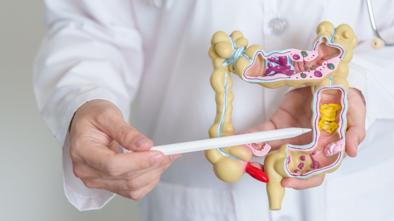 Nhiều polyp có thể được loại bỏ ngay trong quá trình nội soi bằng kìm hoặc thòng lọng chuyên dụng