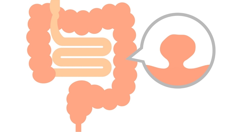 Không phải tất cả polyp đều trở thành ung thư, và nguy cơ phụ thuộc vào nhiều yếu tố