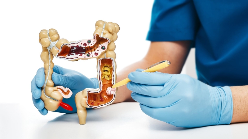 Việc polyp không có cuống không có nghĩa là polyp chắc chắn bị ung thư