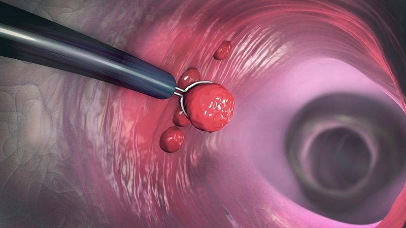 Cắt polyp đại tràng có phải kiêng quan hệ không? Những điều cần biết 1