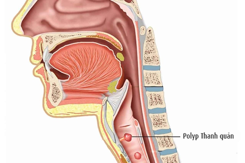 Cắt polyp thanh quản phải kiêng nói bao lâu? -2