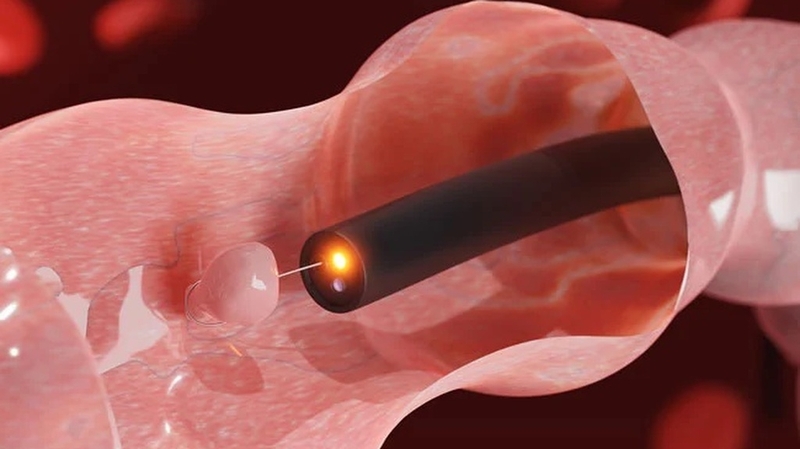 Cắt polyp trực tràng có nguy hiểm không? 5