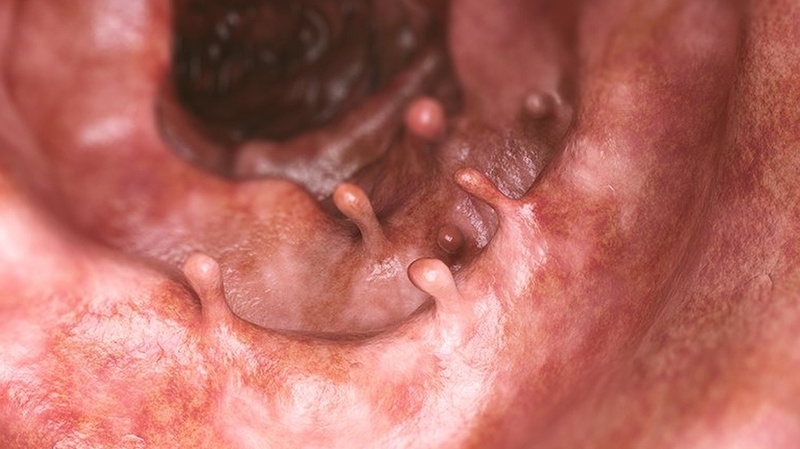 Cắt polyp trực tràng có nguy hiểm không? 3