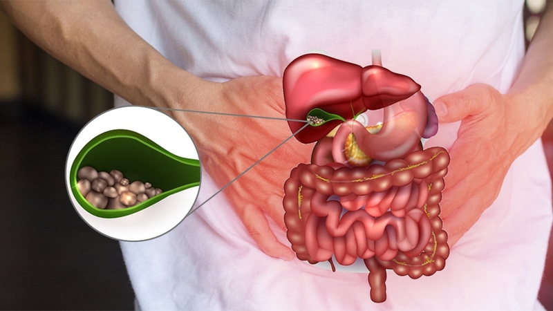 Cắt túi mật bao lâu hồi phục? Những lưu ý sau khi phẫu thuật 1