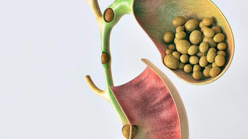 Cắt túi mật bao lâu hồi phục? Những lưu ý sau khi phẫu thuật 2