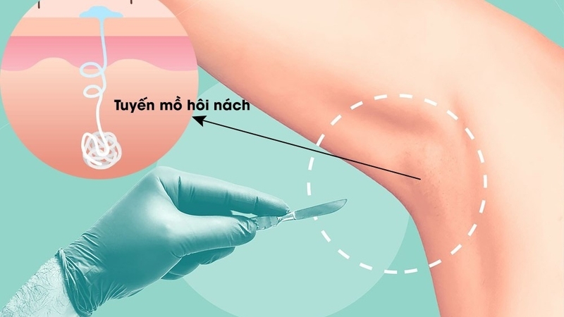 Cắt tuyến mồ hôi nách giá bao nhiêu? Lưu ý sau khi cắt tuyến mồ hôi nách 2