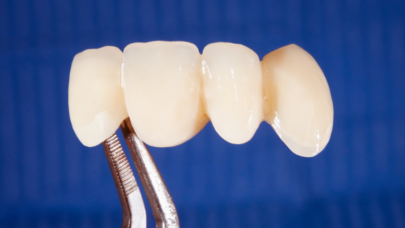 Cầu răng sứ là phương pháp phục hình răng mất phổ biến trong nha khoa