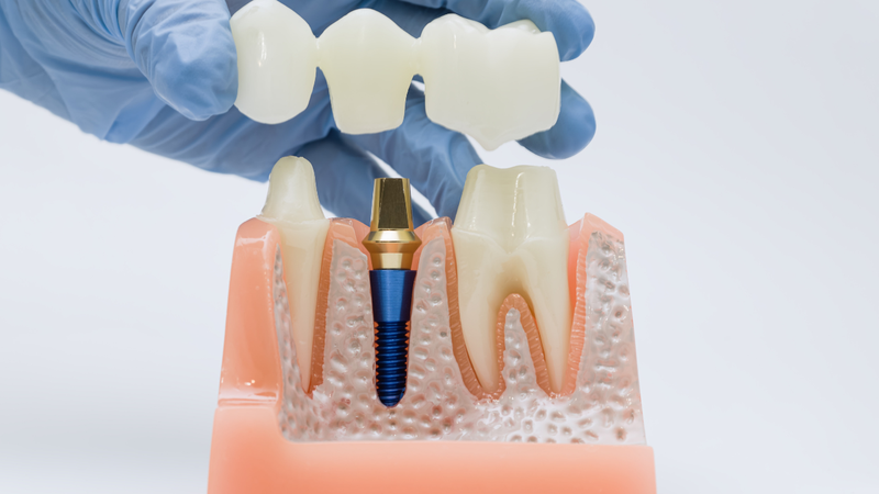 Cầu răng sứ trên trụ Implant có tính thẩm mỹ và độ bền cao