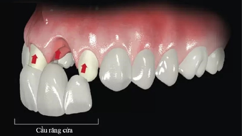 cau-rang-su-rang-cua-la-gi-nhung-dieu-can-luu-y 1