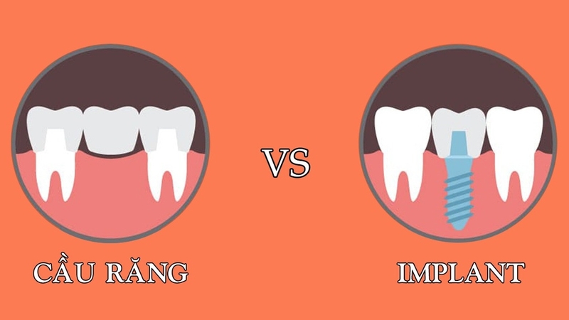 Cầu răng sứ và implant: Nên chọn phương pháp nào? So sánh chi tiết 2