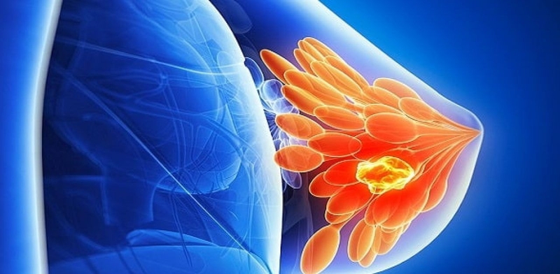 Cấu tạo, chức năng của tuyến vú và các bệnh lý thường gặp 2