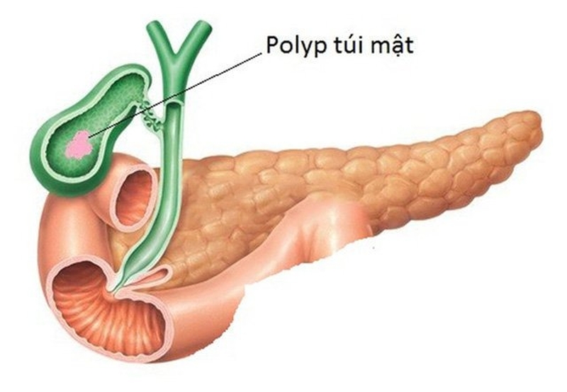 Cây bồ công anh chữa polyp túi mật có hiệu quả không? 1