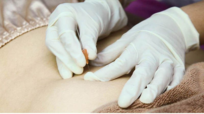 Cấy chỉ: Thông tin từ A đến Z về phương pháp này! 1
