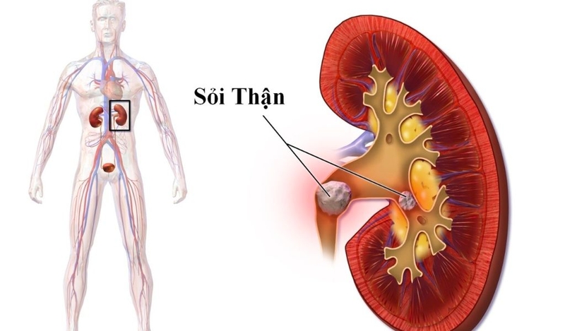 Cây cỏ xước chữa sỏi thận có tốt không? Đối tượng nào có thể sử dụng 2
