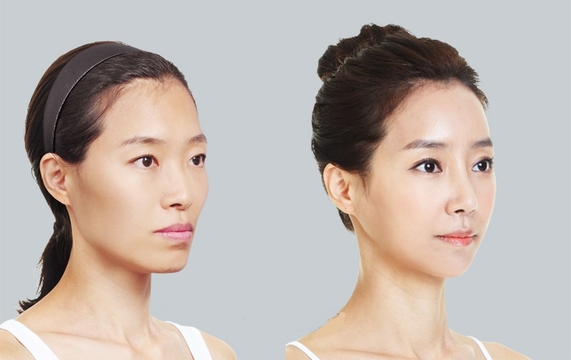 Cấy collagen làm đầy má hóp là gì? Giá bao nhiêu 3