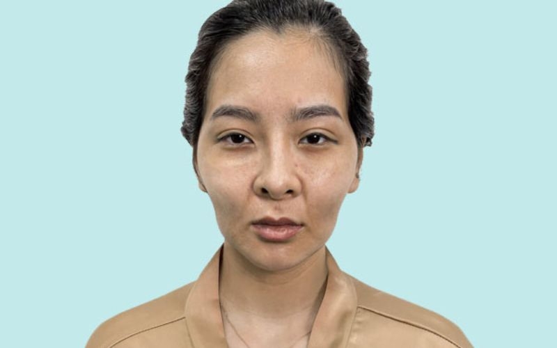 Cấy collagen làm đầy má hóp là gì? Giá bao nhiêu 1