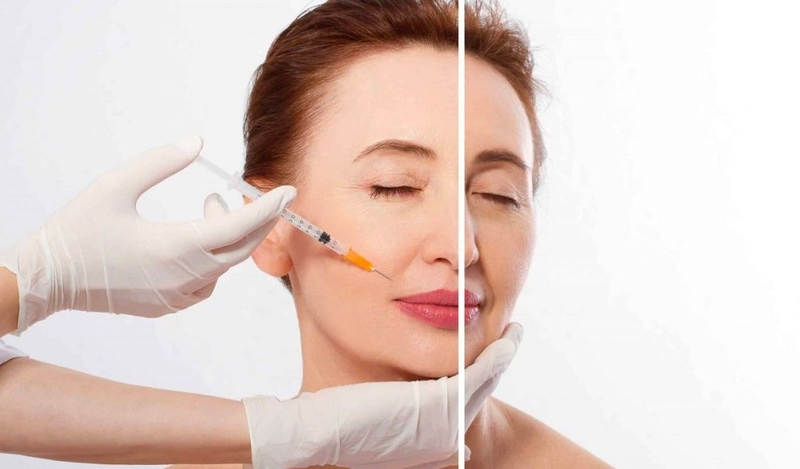 Cấy collagen tươi có tốt không? Duy trì trong thời gian bao lâu? 1