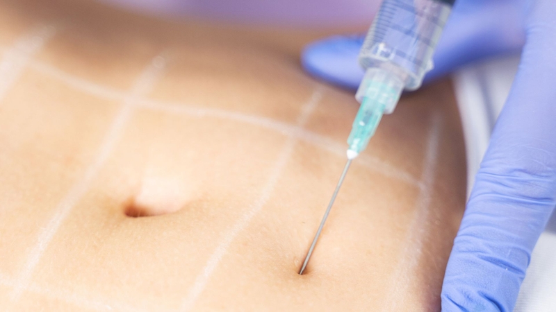 Cấy enzyme giảm mỡ có tốt không? Những lưu ý quan trọng cần biết 1