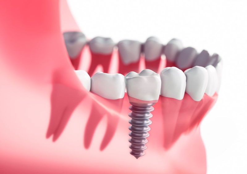 Cấy ghép implant là gì - hiểu ưu và nhược điểm trước khi thực hiện 1