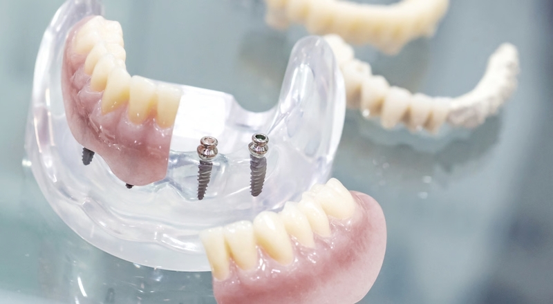 Cấy ghép Mini Implant là gì? Điểm khác biệt và lưu ý sau khi thực hiện
