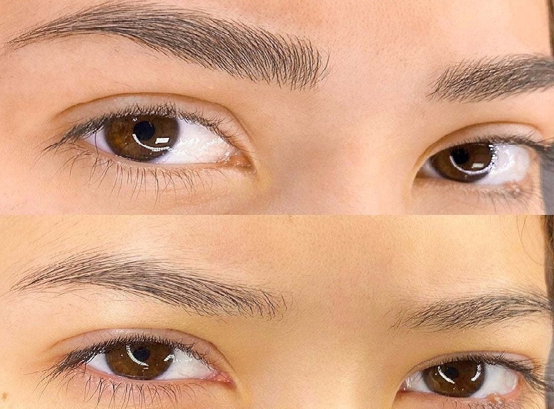 Cấy lông mày về cơ bản là phương pháp cấy một nang lông vào vùng lông mày