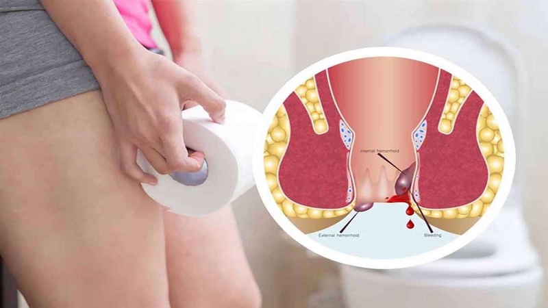 Những điều bạn cần biết về cây lức chữa bệnh trĩ an toàn nhất 4