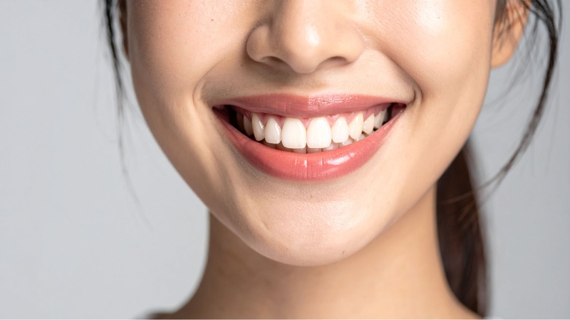 Cấy mỡ rãnh cười giúp gương mặt trông trẻ trung và hài hòa hơn