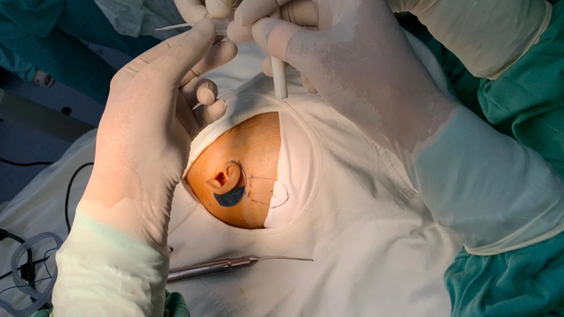 cấy ốc tai điện tử có nguy hiểm không 3